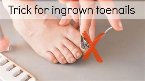 Removing the whole nail makes it more likely that the nail will grow back misshapen or deformed, which can increase the risk of future ingrown. . How to fix ingrown toenails